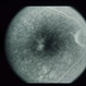 Type II Idiopathic Bilateral Juxtafoveolar Retinal Telangiectasis