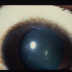 Keratitis Adeno - Retina Image Bank