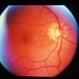 Peripapillary CNVM - ARMD Peripapillary CNVM - ARMD