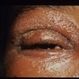 Neomycin Allergy