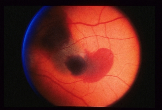 Peripapillary CNVM ARMD Retina Image Bank budget-2024-govt-pushes-for-tribal-development-with-rs-13-000-crore
