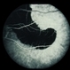 Peripapillary CNVM - ARMD Peripapillary CNVM - ARMD