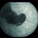Peripapillary CNVM - ARMD Peripapillary CNVM - ARMD
