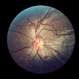 Neomycin Allergy