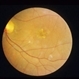Adult Vitelliform Adult Vitelliform