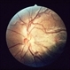 Neomycin Allergy