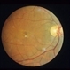 Adult Vitelliform Adult Vitelliform