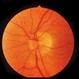 Neomycin Allergy