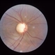 Glaucoma