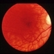 CNVM - Myopic CNVM - Myopic
