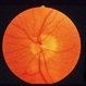 Neomycin Allergy