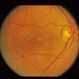 ARMD with perifoveal CNV ARMD with perifoveal CNV