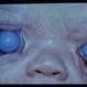 Congenital Glaucoma External Congenital Glaucoma External