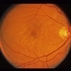 Small Macular Hemorrhage