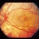 Decreased Central Vision