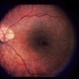 Gyrate Atrophy