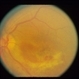 Severe Commotio Retinae With Edema And Hemorrhages