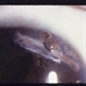 Corneal Laceration Iris In Wound