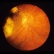 Toxoplasmosis Scar