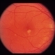 Idiopathic Choroidal Neovasculization (CNV)