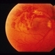 Blurring Of Central And Inferior Visual Field
