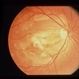 Superior Paracentral Scotoma