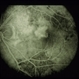 Idiopathic Polypoidal Choroidal Vasculopathy