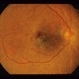 Retinal Degeneration
