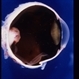 Amelanotic Epibulbar Lesion