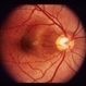 Bilateral Serous Detachments