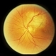 Paracentral Blind Spot And Scotoma