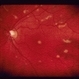 Decreased Visual Acuity (Case 2)