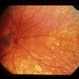 Uveitis