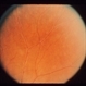 Intraocular Inflammation