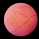Ocular Histoplasmosis With Macular Changes