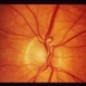 Multiple Retinal Arterial Macroaneurysms