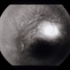 Subretinal Hemorrhage With Exudative Detachment