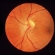 Retinoschisis Secondary To Pars Planitis