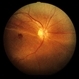 Bilateral Retinal Detachment; Macular Cyst OS