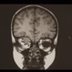 Rhabdomyosarcoma R Orbit