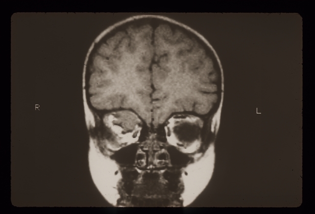Rhabdomyosarcoma R Orbit - Retina Image Bank