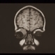 Rhabdomyosarcoma R Orbit