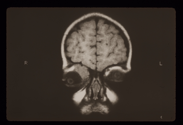 Rhabdomyosarcoma R Orbit - Retina Image Bank