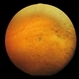 Retinitis Pigmentosa and Cataract