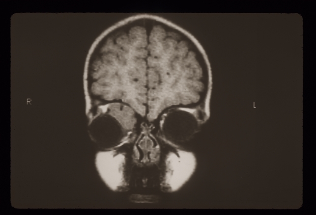 Rhabdomyosarcoma R Orbit - Retina Image Bank