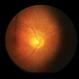 Retinitis Pigmentosa and Cataract