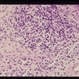 Rhabdomyosarcoma R Orbit