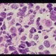Rhabdomyosarcoma R Orbit
