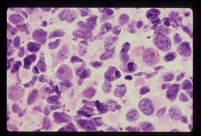 Rhabdomyosarcoma R Orbit - Retina Image Bank