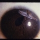 Corneal Laceration Iris In Wound